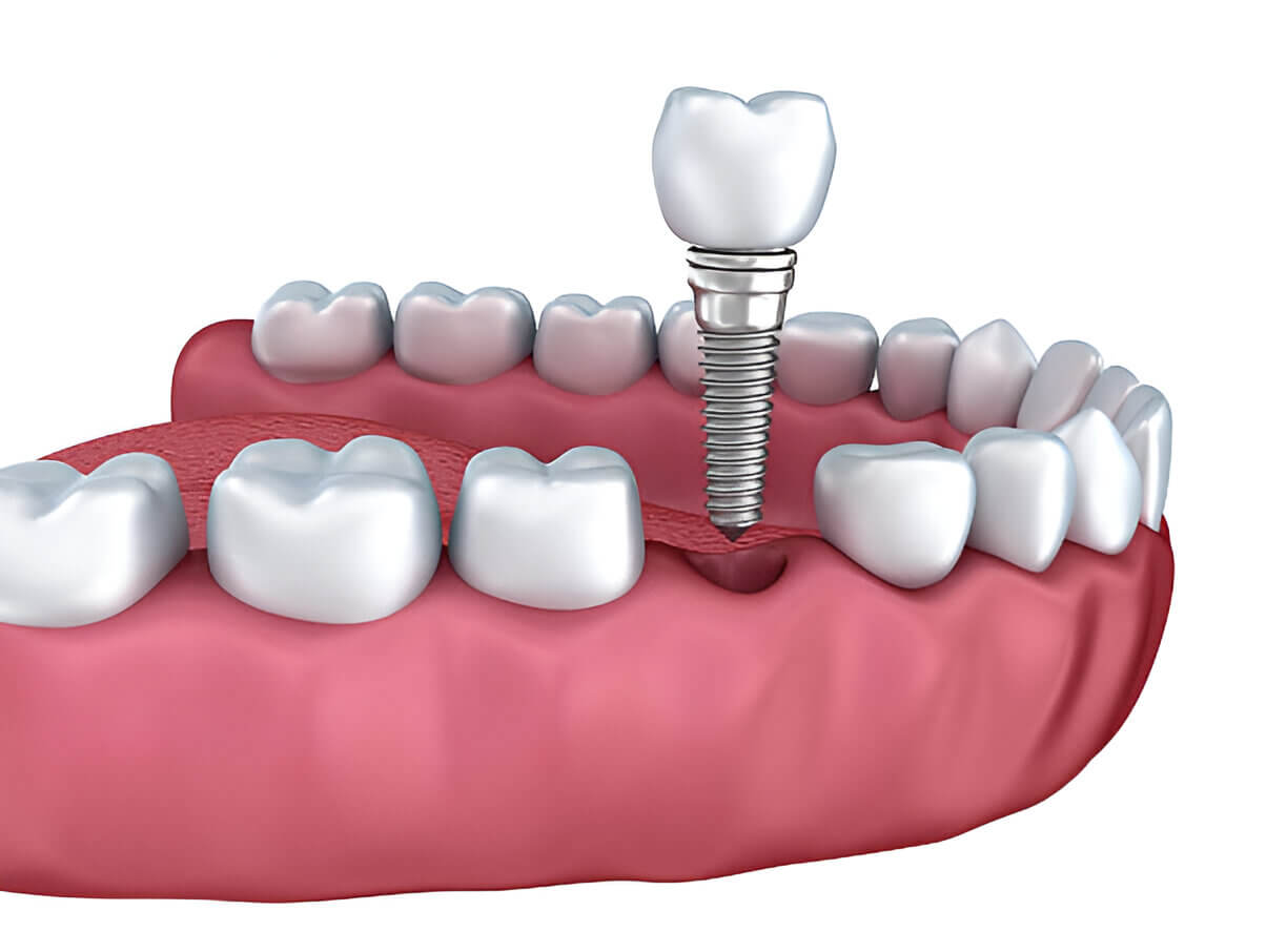 wisdom Teeth removal