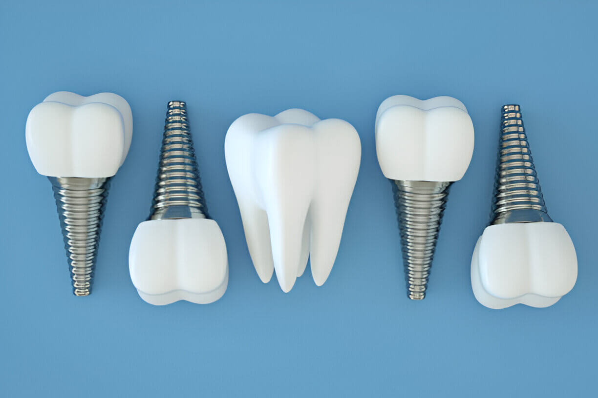 Best Dental Insurance for Implants